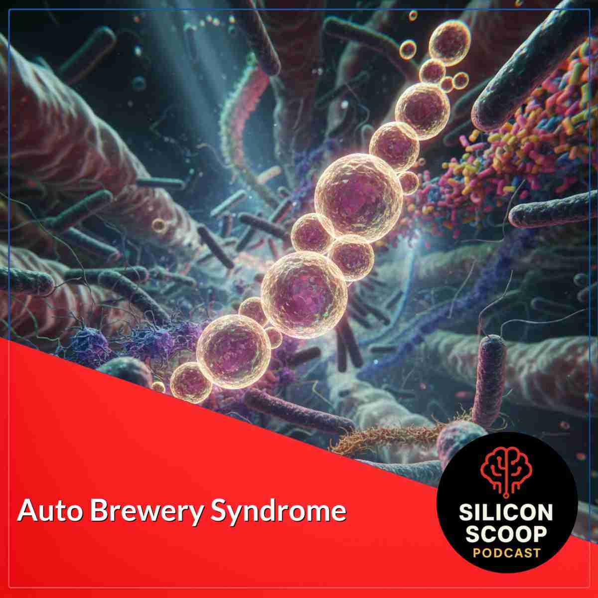Auto Brewery Syndrome: Causes, Symptoms, Diagnosis, and Treatment Options